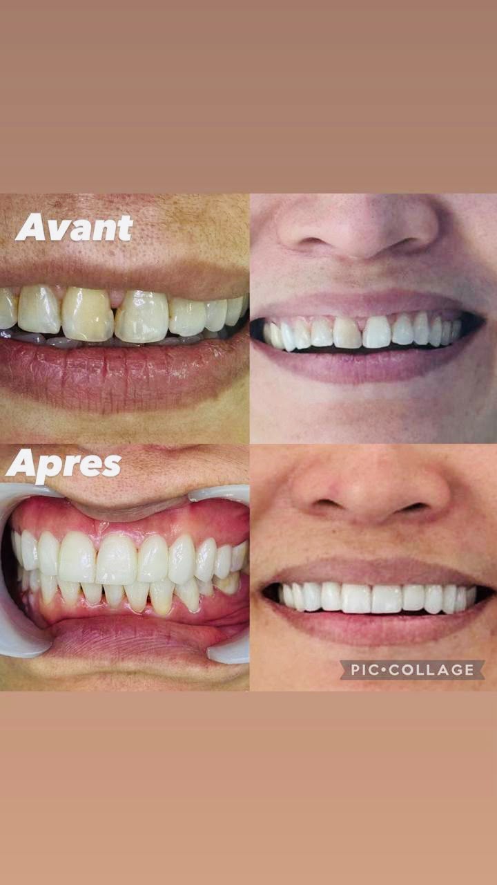 Avant-Après 3